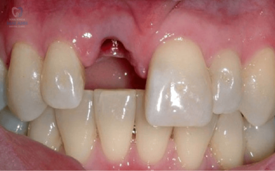 Mất răng - hậu quả và phương pháp khắc phục