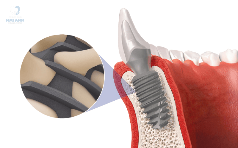 Những điều cần biết trước khi cấy răng implant Những điều cần biết trước khi cấy răng implant