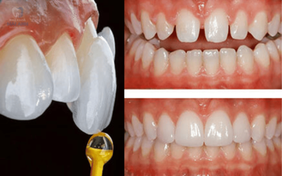 Tìm hiểu về veneer sứ - Dịch vụ làm đẹp răng hiện đại