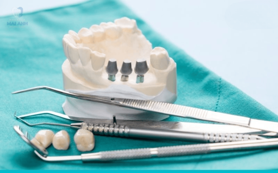 Trồng 1 cái răng bao nhiêu tiền? cập nhật bảng giá 2025