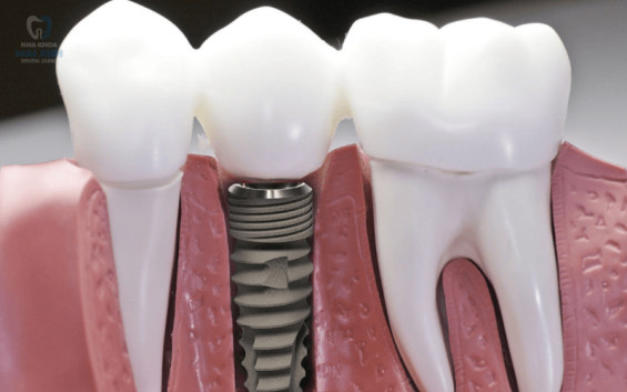 Trồng răng giả giá bao nhiêu? Bảng giá trồng răng giả mới nhất 2025