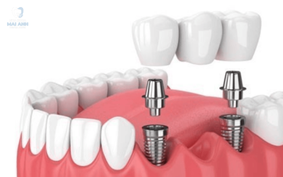 Các phương pháp trồng răng hàm phổ biến hiện nay