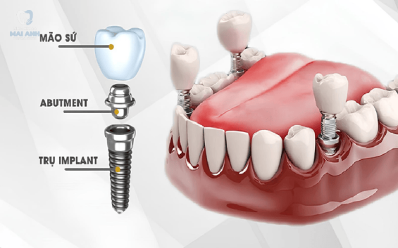 Làm gì để lành thương nhanh sau khi trồng răng Implant? Chi phí trồng răng Implant mới nhất 2025!