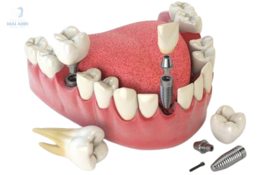 Trồng răng Implant tại TP.HCM - Nơi nào an toàn, uy tín?