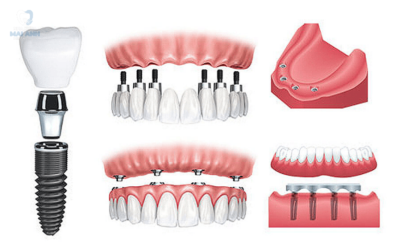 Cần lưu ý gì sau khi trồng răng implant toàn hàm?