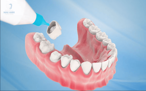 Trồng răng sứ khi bị mất răng: Cần lưu ý những điều gì?