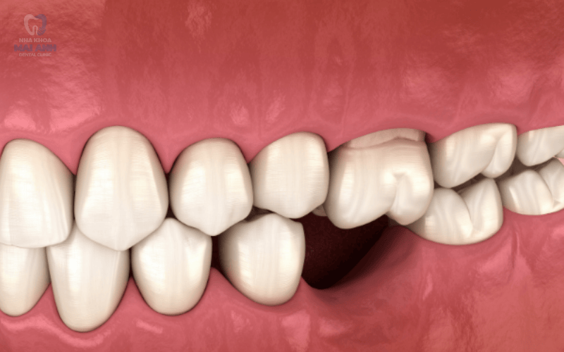 Người bị mất một hoặc nhiều răng