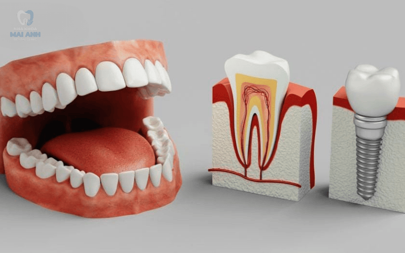 Làm gì để lành thương nhanh sau khi trồng răng Implant? Chi phí trồng răng Implant mới nhất 2025! Làm gì để lành thương nhanh sau khi trồng răng Implant? Chi phí trồng răng Implant mới nhất 2025!