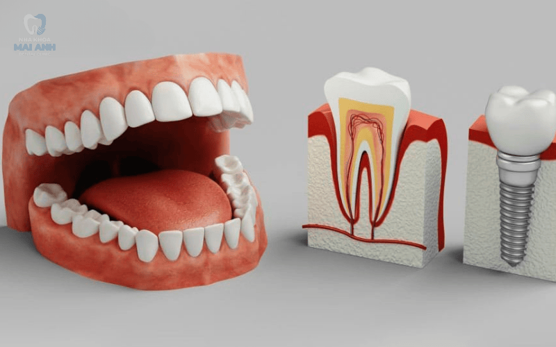 Cần lưu ý gì sau khi trồng răng implant toàn hàm?