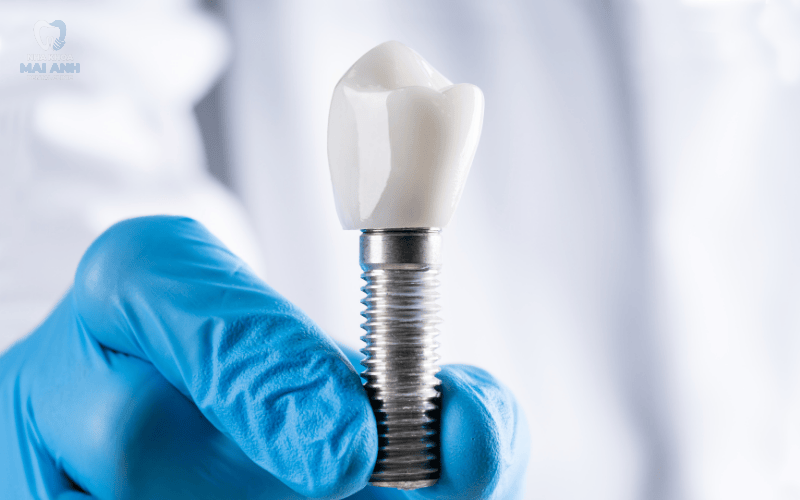 Cần lưu ý gì sau khi trồng răng implant toàn hàm?